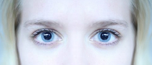 Eye Pupils Dilated